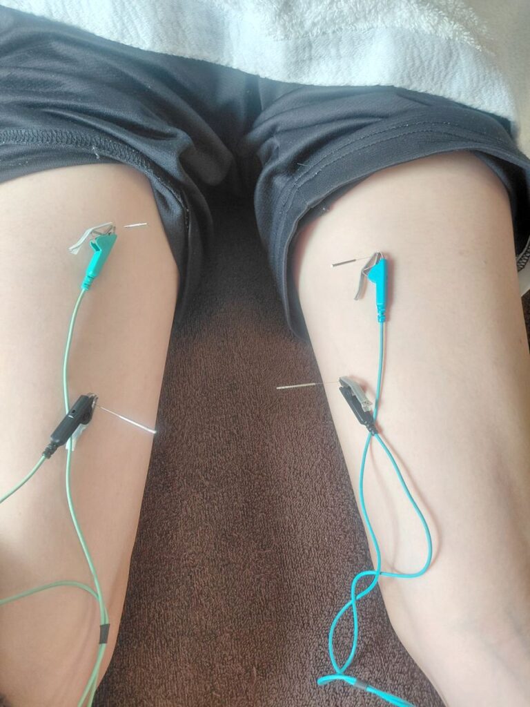 脚への電気鍼